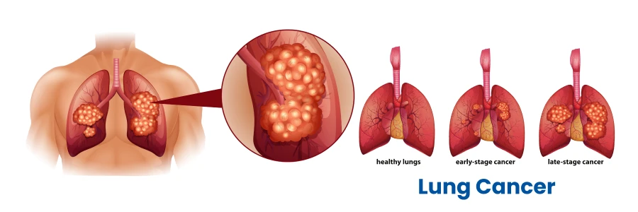 World Lung Cancer Day 2025_4.1