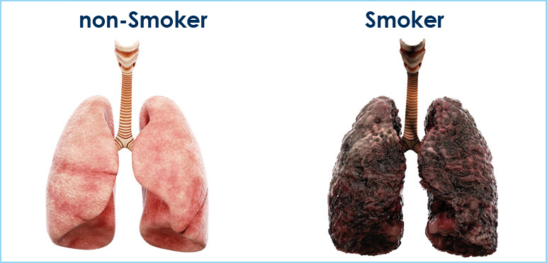 World Lung Cancer Day 2025_6.1